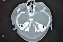 hematoma-subgaleal-hidrocefalia-tac-rnm-1998-022