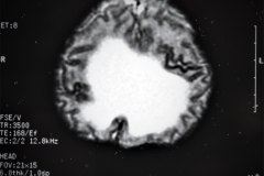 hematoma-subgaleal-hidrocefalia-tac-rnm-1998-023