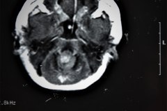 hematoma-subgaleal-hidrocefalia-tac-rnm-1998-024