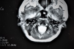 hematoma-subgaleal-hidrocefalia-tac-rnm-1998-032
