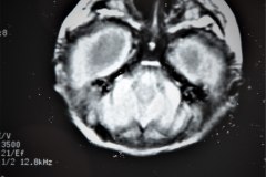 hematoma-subgaleal-hidrocefalia-tac-rnm-1998-034