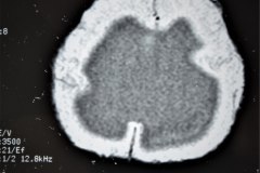 hematoma-subgaleal-hidrocefalia-tac-rnm-1998-035
