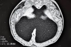 hematoma-subgaleal-hidrocefalia-tac-rnm-1998-043