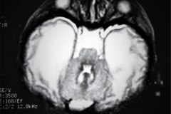 hematoma-subgaleal-hidrocefalia-tac-rnm-1998-044