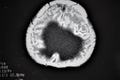 hematoma-subgaleal-hidrocefalia-tac-rnm-1998-046
