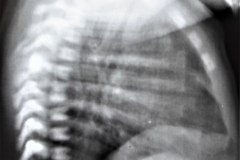 hemivertebra-t-5-union-costal-bil-003
