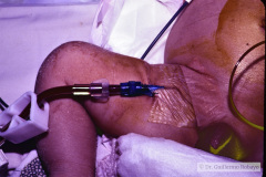 hemodiafiltracion-15-d-1994_03_17-h-blanca-vizcaya-001