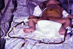 hemodiafiltracion-15-d-1994_03_17-h-blanca-vizcaya-004