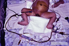hemodiafiltracion-15-d-1994_03_17-h-blanca-vizcaya-008