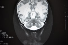 hemorragia-cerebral-secuela-encefalomalacia-rnm-1998-016