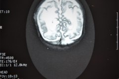 hemorragia-cerebral-secuela-encefalomalacia-rnm-1998-022