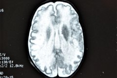 hemorragia-cerebral-secuela-encefalomalacia-rnm-1998-031