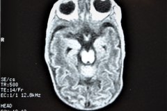 hemorragia-cerebral-secuela-encefalomalacia-rnm-1998-035