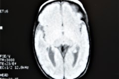 hemorragia-cerebral-secuela-encefalomalacia-rnm-1998-043