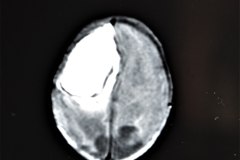 hemorragia-hematoma-intracerebral-y-subdural-rnm-001