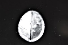 hemorragia-hematoma-intracerebral-y-subdural-rnm-004