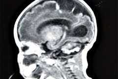 hemorragia-hematoma-intracerebral-y-subdural-rnm-005