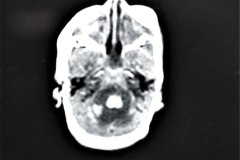 hemorragia-hematoma-intracerebral-y-subdural-rnm-007