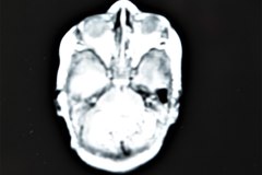 hemorragia-hematoma-intracerebral-y-subdural-rnm-011