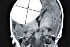 hemorragia-hematoma-intracerebral-y-subdural-rnm-016