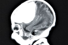hemorragia-hematoma-intracerebral-y-subdural-rnm-018