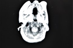 hemorragia-hematoma-intracerebral-y-subdural-rnm-020