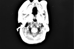 hemorragia-hematoma-intracerebral-y-subdural-rnm-021