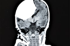 hemorragia-hematoma-intracerebral-y-subdural-rnm-025