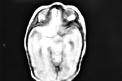 hemorragia-hematoma-intracerebral-y-subdural-rnm-027