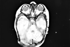 hemorragia-hematoma-intracerebral-y-subdural-rnm-028