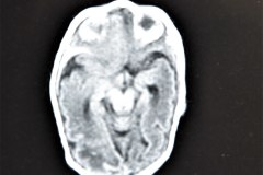 hemorragia-hematoma-intracerebral-y-subdural-rnm-029