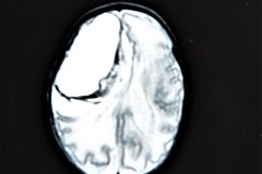 hemorragia-hematoma-intracerebral-y-subdural-rnm-030