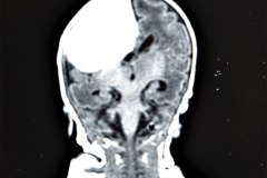 hemorragia-hematoma-intracerebral-y-subdural-rnm-036