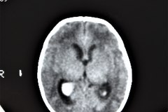 hemorragia-intracerebral-intracerebelosa-intraventricular-tac-2013-002