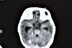 hemorragia-intracerebral-intracerebelosa-intraventricular-tac-2013-004