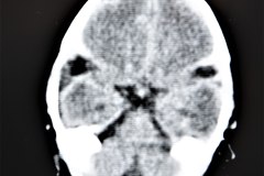 hemorragia-intracerebral-intraventricular-tac-1998-000