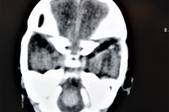hemorragia-intracerebral-intraventricular-tac-1998-001