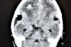 hemorragia-intracerebral-intraventricular-tac-1998-002