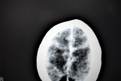 hemorragia-intracerebral-intraventricular-tac-1998-003