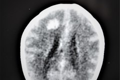 hemorragia-intracerebral-intraventricular-tac-1998-004