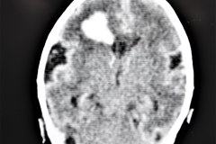 hemorragia-intracerebral-intraventricular-tac-1998-006