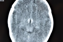 hemorragia-intraventricular-1998-002