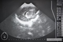hemorragia-intraventricular-cuerno-occipital-1987-004
