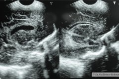 hemorragia-intraventricular-dilatacion-ventricular-pret-tac-2005-002