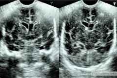 hemorragia-intraventricular-dilatacion-ventricular-pret-tac-2005-003