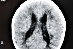 hemorragia-intraventricular-ecografia-tac-1995-000