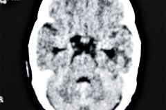 hemorragia-intraventricular-ecografia-tac-1995-002