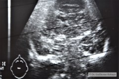 hemorragia-intraventricular-ecografia-tac-1995-005