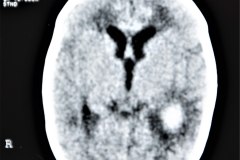 hemorragia-intraventricular-ecografia-tac-1995-006