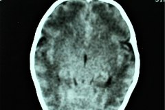 hemorragia-intraventricular-tac-1994-002